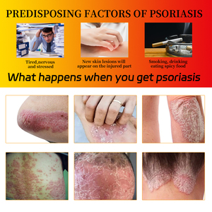Krim eksim <span class=keywords><strong>Psoriasis</strong></span> 20g, salep Triethanolamine jerawat Bee Venom Dermatitis skrotum eksim - Product Image 5