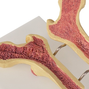 Modèle de fémur ostéoporotique-Comparaison de la densité osseuse transversale pour l'enseignement orthopédique et l'éducation gériatique - Product Image 3