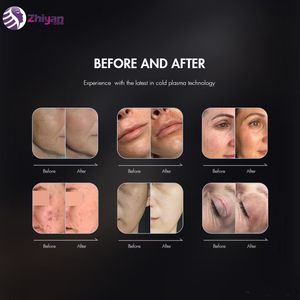 Profesyonel Fibroblast Plazma Kalemi Makinesi Evde Kullanım Soğuk Lazer Terapi Cihazı Soğuk Plazma Makinesi Güzellik Tedavileri İçin - Product Image 6