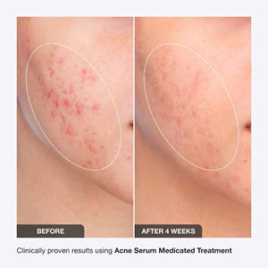 Marque privée Doux Naturel Enlever L'acné et Les Boutons Répare Le Sérum <span class=keywords><strong>Visage</strong></span> Glow and Clean Cicatrices D'acné Essence De Peau Du <span class=keywords><strong>Visage</strong></span> - Product Image 3