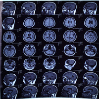 Film Termal Medis Kering 8x10 Inci Biru PET untuk Pencetakan Diagnostik Radiologi Rumah Sakit