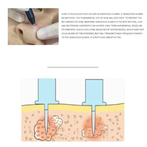 OEM ODM Personal Care Equipment Sonic Acne Treatment Skin Whitening Beauty Machine - Product Image 5