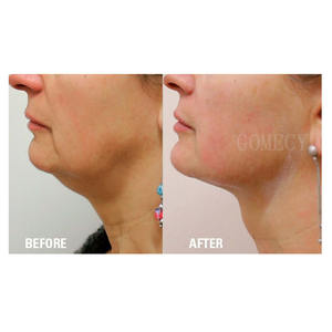 เครื่องเลเซอร์ไดโอด 1470 980 นาโนเมตร สำหรับรักษาโรคหลอดเลือดฝอย เส้นเลือดขอด เครื่องสลายไขมันแบบ Endolaser <span class=keywords><strong>ลด</strong></span>ไขมันส่วนเกิน เครื่องลดสัดส่วน - Product Image 5