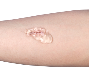 OEM Medical Antimicrobial Silver Hydrogel <strong>Wound</strong> Gel Amorphous Hydrogel Dressing for Burns <strong>Wound</strong> &amp; <strong>Diabetic</strong> Foot Healing - Product Image 6