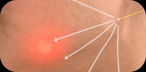 Máquina de Láser Diodo Endolaser de 1470nm y 980nm para Lifting Facial, Liposucción, Cirugía Plástica y Tratamiento de Eliminación de Bolsas de Ojos - Product Image 6