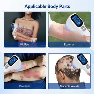Equipo <span class=keywords><strong>de</strong></span> Terapia <span class=keywords><strong>de</strong></span> Luz Excimer UVB <span class=keywords><strong>de</strong></span> 308nm Ajustable y Dirigido <span class=keywords><strong>para</strong></span> Vitiligo Localizado, Vitiligo en <span class=keywords><strong>el</strong></span> Cuello, Psoriasis y Eccema en las <span class=keywords><strong>Manos</strong></span> - Product Image 3
