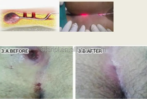 <span class=keywords><strong>Hemorroides</strong></span> Cirugía de fibra cónica 1470nm 980nm Proctología médica Fístula anal Pilas Recto Sinus Diodo <span class=keywords><strong>Tratamiento</strong></span> de corte - Product Image 5