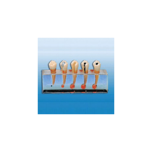 Modèle scientifique médical BIX-L1011, processus pathologique, caries dentaire, pulpite, abcès radiculaire, maladie endodontique, mannequin - Product Image 1