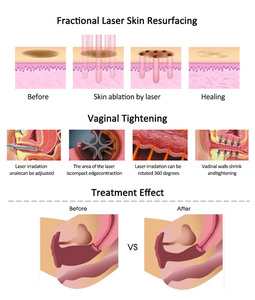 Portable High <b>Strength</b> CO2 Laser for Acne <b>Scars</b> Skin Resurfacing Machine 10600nm Commercial Use - Product Image 5