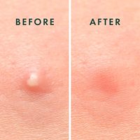Patchs Hydrocolloïdes Discrets pour l'Acné, 96 Unités, Étiquette Privée, Invisibles, Imperméables, Couvre-Imperfections, Soin Quotidien de la Peau