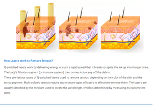 הזדמנויות עסקיות מפיץ המחיר הטוב ביותר הסיטונאי q החליף לייזר הסרת קעקוע - Product Image 2