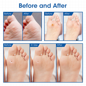 Meilleure Vente MQ Chinois 100% Naturel Pansements Dissolvants de Callosités Certifiés CE Dispositif Médical Classe I Acide Salicylique Usage Quotidien 2 Ans - Product Image 3