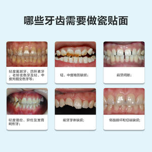 Facettes dentaires en porcelaine bleue tout céramique Dentsply Ivoire, faits à la main, en porcelaine ambrée, sans grincement des dents - Product Image 3