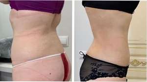 עיצוב חדש באיכות גבוהה 980nm 1470nm לייזר ליפוליזיס מכונת שאיבת שומן להסרת קמטים לקווי מתאר פנים - Product Image 6