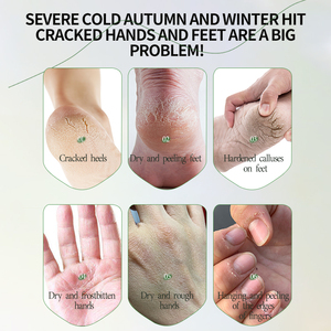 OKADY ODM OEM OBM 40% CRÈME D'URÉE + 2% ACIDE SALICYLIQUE Hydrater <span class=keywords><strong>et</strong></span> Nourrir Crème Pour Le Corps pour Femmes Hommes <span class=keywords><strong>Pieds</strong></span> <span class=keywords><strong>et</strong></span> Main Protecteur De Soins De La Peau - Product Image 4