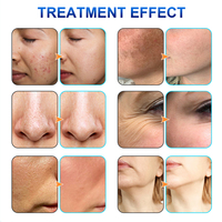 Multifunctionele Hydrodermabrasie Aqua Peel-Ultrasounic-Rf Hydrodermabrasie Gezichtshandstuk Reserveonderdelen