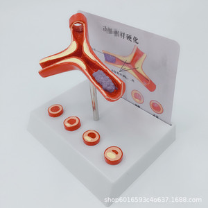 Modelo de anatomía vascular humana; modelo vascular; demostración de arteriosclerosis; vasos sanguíneos en diferentes etapas de edad. - Product Image 3
