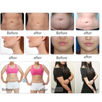 Equipo de Criolipólisis 360 con 5 Manijas, Vacumterapia, Cavitación, Radiofrecuencia, Pérdida de Peso, Moldeado Corporal, Equipo de Crioterapia para Salón