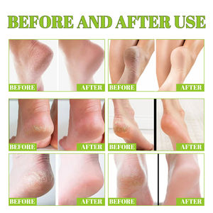 South Moon crème hydratante éclaircissante adoucissante anti-fissuration pour les mains <span class=keywords><strong>d</strong></span>'<span class=keywords><strong>athlète</strong></span> crème pour les pieds à l'acide salicylique et à l'urée - Product Image 2