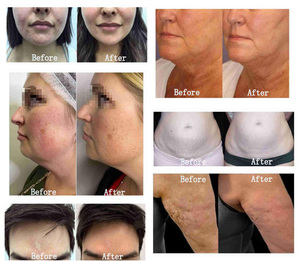 Beauty Sap Salon Facial Lifting Slim Face Lift <b>Massage</b> <b>Machine</b> Skin Tightening Dark Circle Remover Wrinkle Remover Standing - Product Image 6