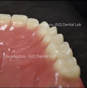Las dentaduras postizas de boca completa personalizadas, los dientes acrílicos ofrecen una estabilidad mejorada para masticar, comer y hablar con un precio asequible - Product Image 3