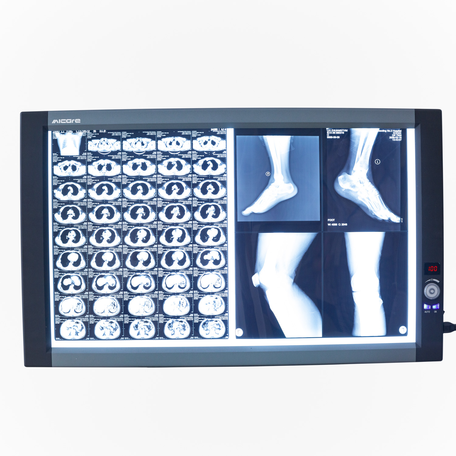 Micare Verstelbare Medische Led X-Ray Viewer View Box Medische Imaging Apparatuur Dubbele X-Ray Films Met Sensor