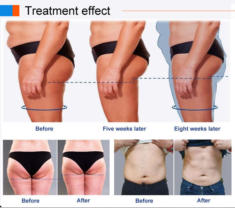 emsculpt machine before and after