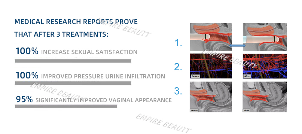 female intimate areal Tightening Machine RF Ultrasound Technology 2 In 1 Ultra 360 For Femme Care Ultra RF 360 Degree