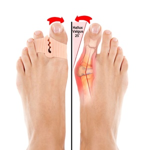 MediFootCare ortopédico superpuesto dedos grandes juanete Corrector dedo del pie espaciadores esparcidor Gel dedo del pie separadores para mujeres <span class=keywords><strong>sandalias</strong></span> de Tanga - Product Image 5