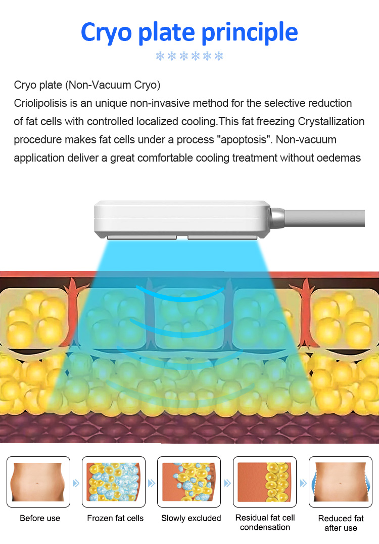 cryo plate principle