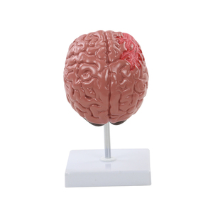 Modelo de Cerebro Humano con <span class=keywords><strong>Derrame</strong></span> Cerebral - Modelo Anatómico de Enfermedad Cerebral Patológica - Hemorragia Cerebral - Lesión Cerebral - Product Image 3