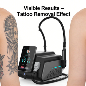 Máquina Láser Nd de Picosegundos de 2000W, la Más Popular en la UE, para Eliminación de Tatuajes, Eliminación de Manchas de Sangre, Atenuación de Cicatrices y Peeling de Carbono - Product Image 5