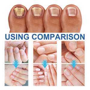 Traitement antifongique de haute qualité pour les ongles, crème réparatrice pour ongles gris, ongles doux - Product Image 4