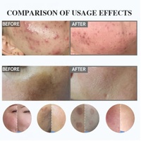 Traitement Anti-Taches Visage Hyperpigmentation, Mélasma et Taches de Rousseur: Crème Éliminatrice de Taches Foncées pour le Soin de la Peau à Base de Spicules d'Éponge