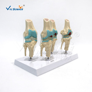 Matériel éducatif VIC190104 : Modèle d'articulation du genou humaine à 4 étapes de dégénérescence - Product Image 1