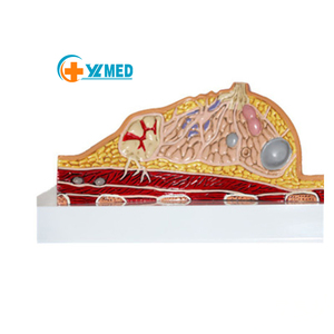 نموذج سرطان الثدي الأنثوي بالحجم الطبيعي نموذج فحص الثدي المرضي للإناث نماذج تشريحية للتعليم الطبي - Product Image 1