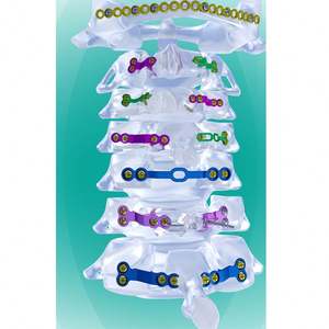 Sistem Bedah Laminoplasti Serviks Posterior Berkualitas Tinggi untuk Dekompresi Tulang Belakang yang Ditingkatkan - Product Image 1