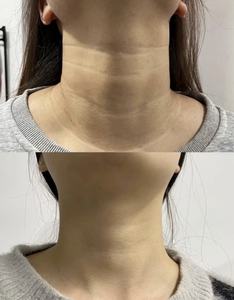 סרום חומצה היאלורונית נגד קמטים, תמצית לחות ומיצוק לעור, סרום לטיפוח עור הצוואר - Product Image 3