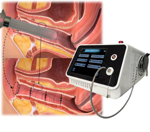 Tratamiento Ginecológico de Rejuvenecimiento <span class=keywords><strong>Vaginal</strong></span> con Láser LVR, Cirugía con Láser de Fibra Endovenosa de 980nm y 1470nm para la Laxitud y Sequedad <span class=keywords><strong>Vaginal</strong></span>, Láser Ginecológico - Product Image 1