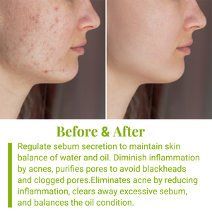 OEM ODM SEDEX <span class=keywords><strong>AUDIT</strong></span> arbre à thé Crème pour le visage Crée une crème anti-acné pour la peau <span class=keywords><strong>d</strong></span>élicate - Product Image 3