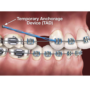 Kit de presa elástica de fábrica profesional Camara <span class=keywords><strong>Shining</strong></span> <span class=keywords><strong>3D</strong></span> <span class=keywords><strong>Aoralscan</strong></span> escáner intraoral banda de goma para dentista - Product Image 3
