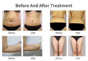 New Non-invasive LipoBody Shaping Machine Desktop Fat Burning Cellulite Removal for Arms, Legs, <b>Buttocks</b> and Abdomen - Product Image 4