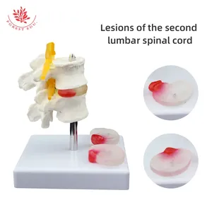 Modello di patologia della colonna lombare FRT038 Herniat disk modello patologico della Vertebra lombare umana - Product Image 6