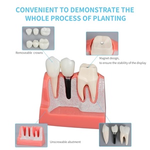 4 Times Medical Science Education Studying Dental Implant Model Removable <b>Teeth</b> Multi-Purpose <b>Teeth</b> <b>Whitening</b> Accessories - Product Image 2