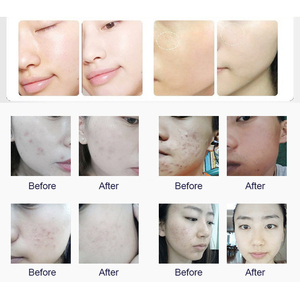 Nueva Máquina de Cuidado Facial 360 6 en 1 con Oxígeno, Microdermoabrasión, Limpieza Facial, Eliminación de Puntos Negros, Máquina de Belleza Facial - Product Image 6