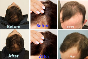 أحدث استخدام طبي 650nm LLLT خوذة نمو الشعر بالليزر ديود لفقدان الشعر علاج الثعلبة إعادة نمو الشعر - Product Image 5