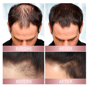 Biểu Tượng Tùy Chỉnh 100% Tinh Khiết Tự Nhiên Tinh Dầu Gạo Nutrion Phun Tăng Trưởng Tóc Phun Cho Mỏng Tóc & Rụng Tóc - Product Image 5