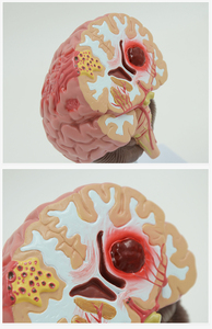 SCIEDU Modelo De Anatomia Do Cérebro Humano Hemorragia Artéria Cerebral Malformação Arteriovenosa Cerebral Patologia Cerebral Modelo Cerebral - Product Image 6