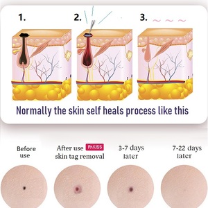 ปากกาพลาสมาไฟโบรบลาสต์ กำจัดไฝ กระ จุดด่างดำ รอยสัก หูด กำจัดรอยแผลเป็น ขายดี - Product Image 2