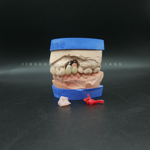 Geschroefd Implantaat Ondersteund Hybrident Kunstgebit Titanium Bar Zirconia Kronen Hoge Nauwkeurigheid China Tandheelkundig Lab - Product Image 4